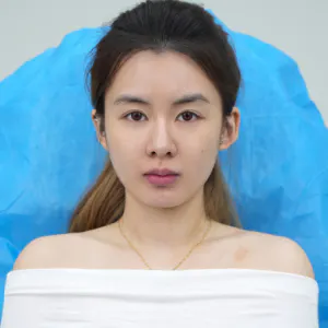 长颌矫正 5