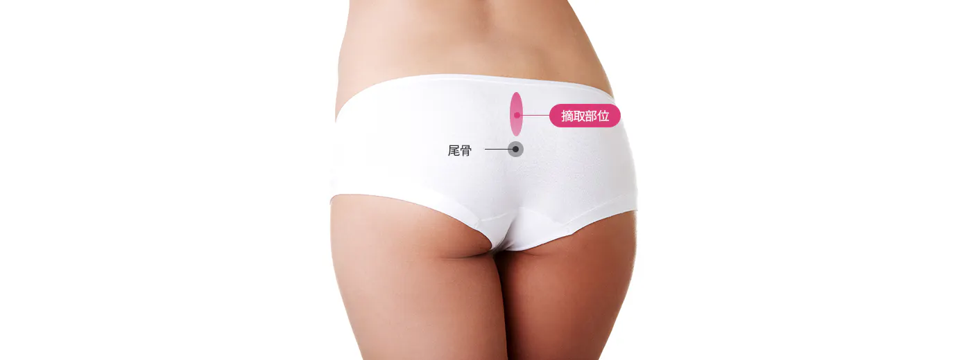 自体真皮 1