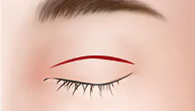 眼形矫正 3