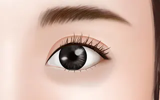 双眼皮手术方法 4