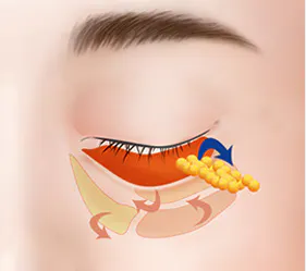 手术方法 3