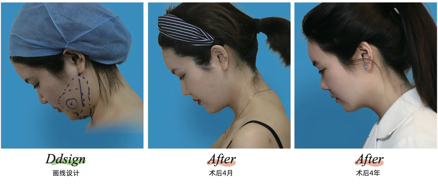 Facial liposuction 4