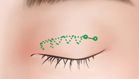手术方法 4