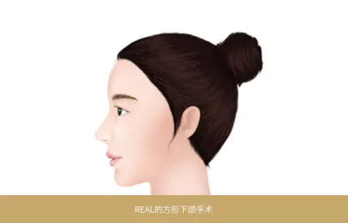 REAL的方形下颌手术
