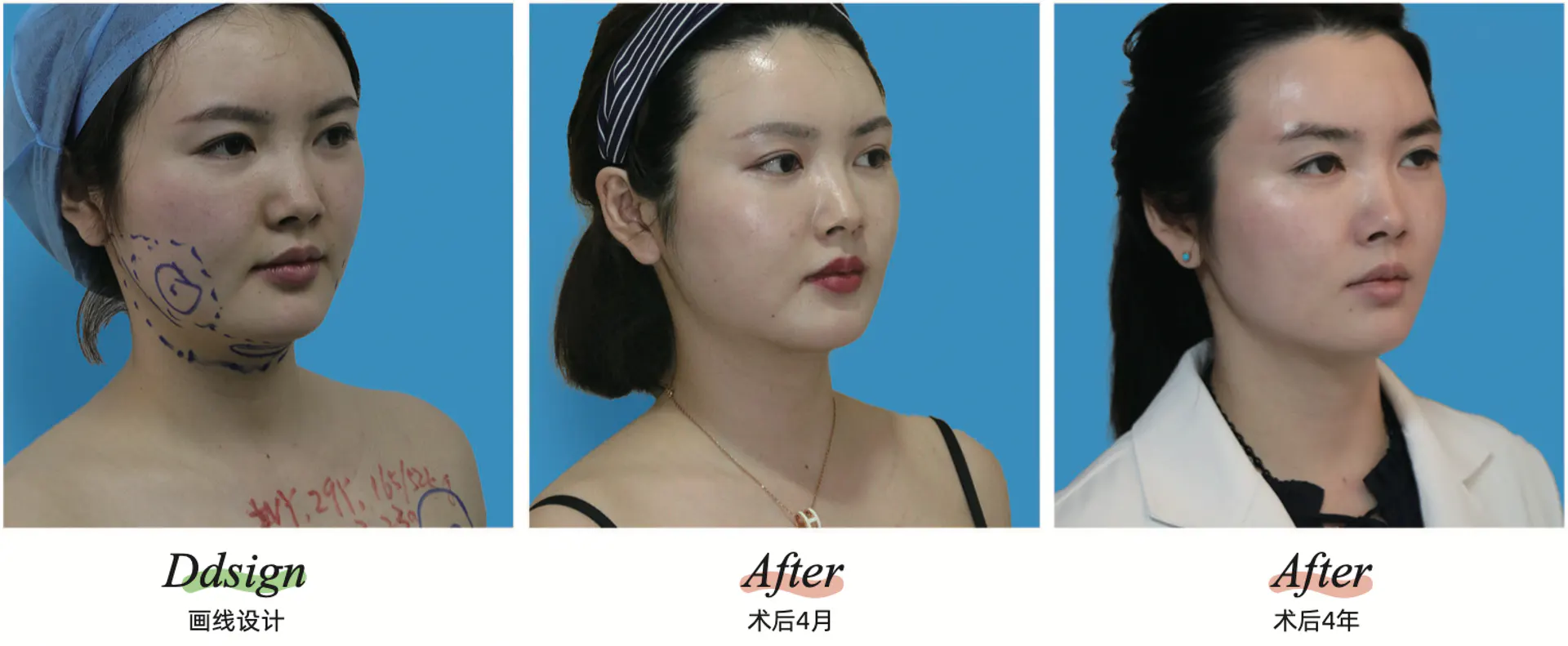 Facial liposuction 2