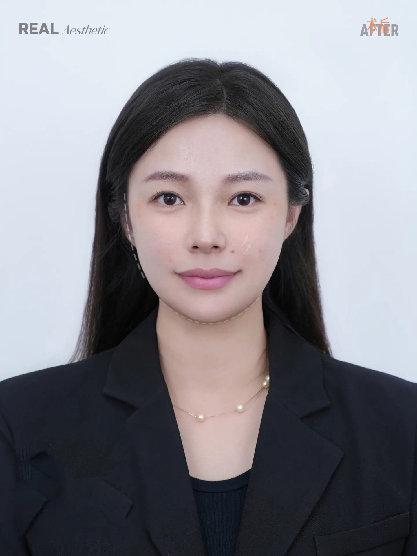 眼部手术后记 1