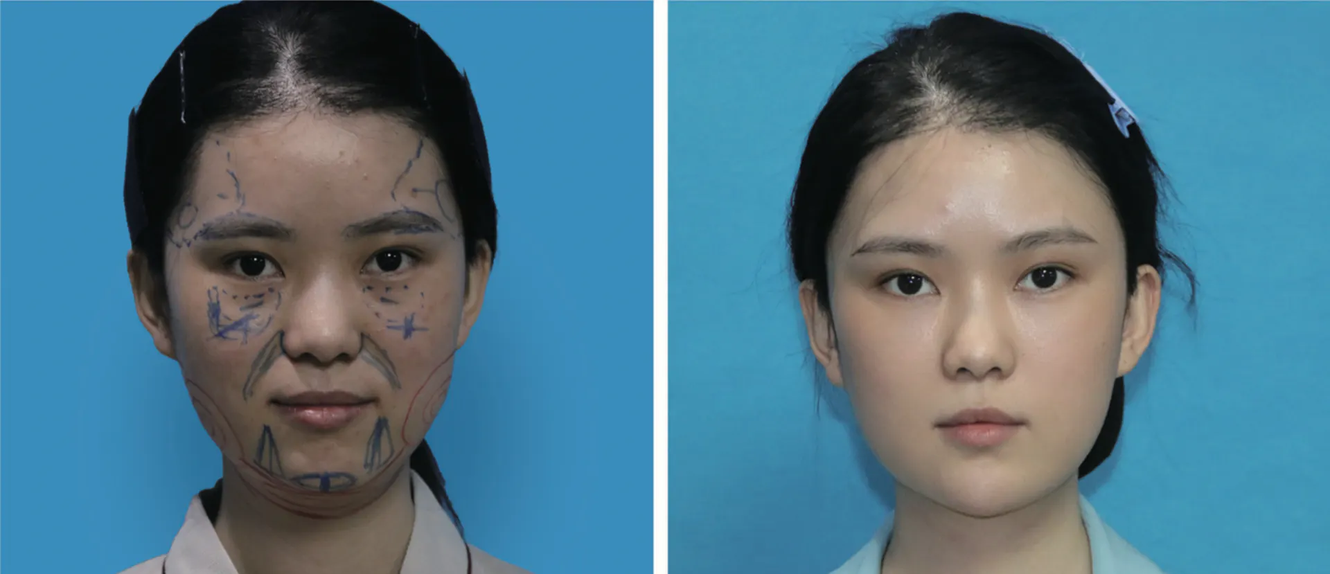 Facial liposuction 14